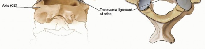 Illustration 6 for Master Techniques for Cervical Fracture Reduction: Type III & More