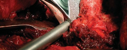 Illustration 29 for Cementless Femoral Stems: Master Indications & Avoid Pitfalls