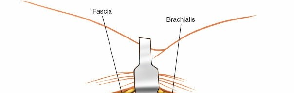 Illustration 32 for Mastering Elbow Approaches: Applied Surgical Anatomy for Precision
