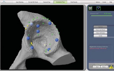 Illustration 29 for Robotics in Total Hip Arthroplasty: A New Era of Precision