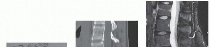 Illustration 7 for Mastering High-Grade Spondylolisthesis: Posterolateral and Interbody Fusion