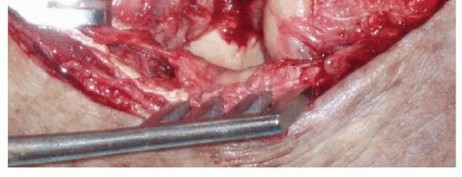 Illustration 17 for Restore Stability & Motion: Fixation of Fracture-Dislocations