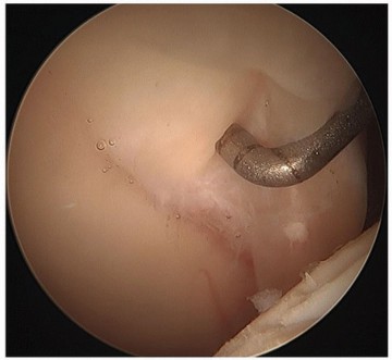 Illustration 2 for Hip Pain Relief: Arthroscopy for Nonstructural Pathology