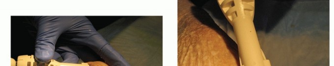 Illustration 68 for End Articular Cartilage Loss: Arthrosurface HemiCAP Resurfacing