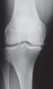 Illustration 11 for Guide Pin Assembly: Key to Flawless Upper Tibial Osteotomy
