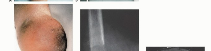 Illustration 10 for Mastering Above-Knee Amputation: Essential Surgical Insights