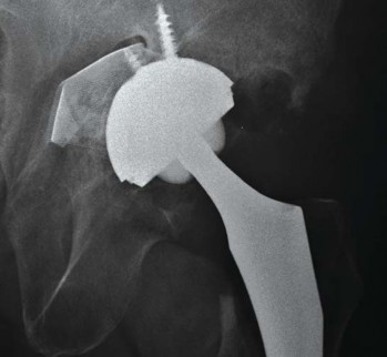 Illustration 33 for Management of Periprosthetic Fractures: An Expert Surgical Guide