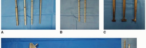 Illustration 16 for Cement in Cement Revision: Simplifying Complex Hip Revisions