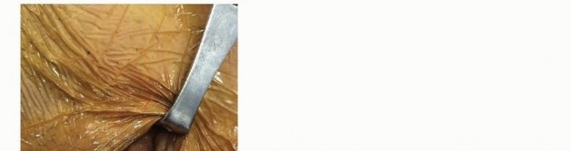 Illustration 41 for Emergency Fixation of the Pelvis: Control Bleeding & Restore Stability