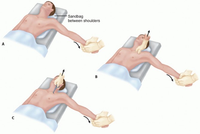 Illustration 16 for Optimizing SC Dislocation Repair After Medial Clavicle Resection