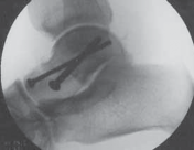 Illustration 22 for Talar Neck Fracture Treatment: Optimizing Recovery with ORIF