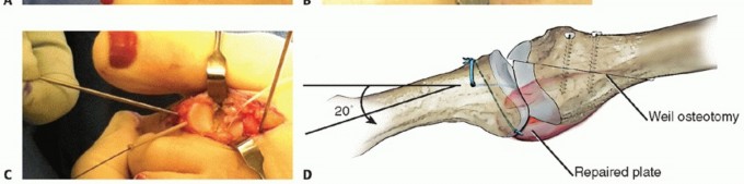 Illustration 22 for Toe Deformity Pain? Rebalance Flexor to Extensor for Relief