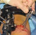 Illustration 11 for Conquering Adolescent Blount's Disease: A Surgical Guide