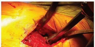 Illustration 6 for The Tapered Stem: Your Guide to Durable Cementless Hip Fixation