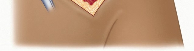 Illustration 26 for Mastering the Treatment of Recurrent Posterior Shoulder Instability