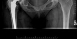 Illustration 2 for Solving Severe Acetabular Bone Loss with Cup-Cage Reconstruction