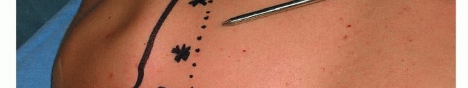 Illustration 16 for Is Your Dorsal Scapular Nerve Causing Snapping Scapula Pain?