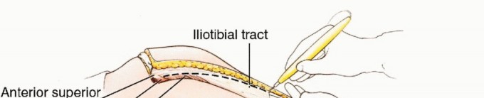 Illustration 17 for Anterior Flap Hemipelvectomy: Leveraging fig tech fig for Difficult Tumors