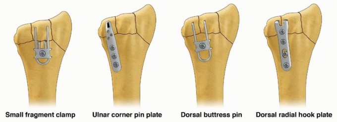 Illustration 3 for Fragment-Specific Fixation: Restore Carpal Facet Horizon