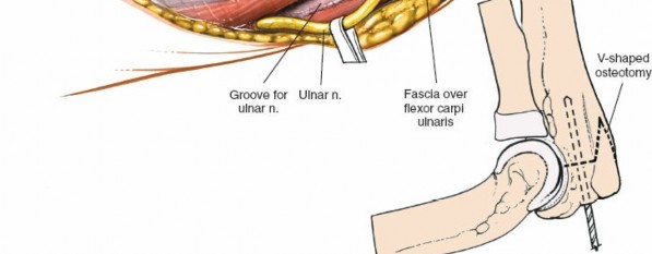Illustration 7 for Mastering Elbow Approaches: Applied Surgical Anatomy for Precision