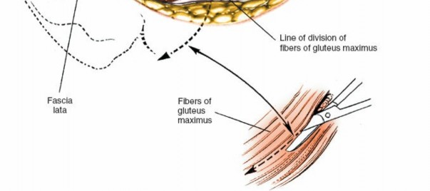 Illustration 123 for Unlocking Every Aspect of the Hip's Surgical Approaches