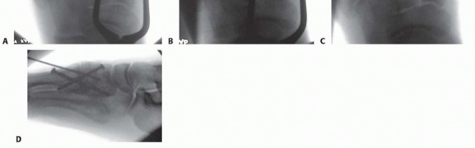 Illustration 18 for Fixation of Lisfranc Injuries: Essential Open Reduction Guide