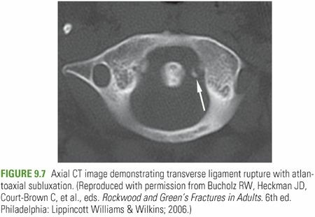 Transverse Ligament Rupture: Recognizing & Treating This Serious Injury