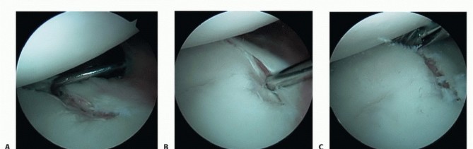 Illustration 4 for Mastering the Treatment of Recurrent Posterior Shoulder Instability