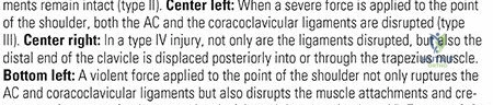 Illustration of clavicle strap sling - Dr. Mohammed Hutaif