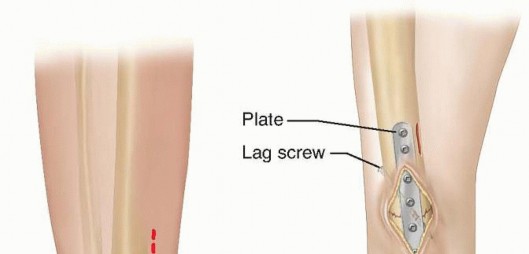 Illustration 8 for Optimal Treatment for Pediatric Tibial Fractures: Key Insights