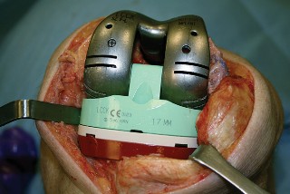 Illustration 28 for Understand Augments: The Role of Metal Augments in Arthroplasty