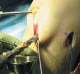 Illustration 44 for Optimizing Single-Bundle Anterior Cruciate Ligament Repair