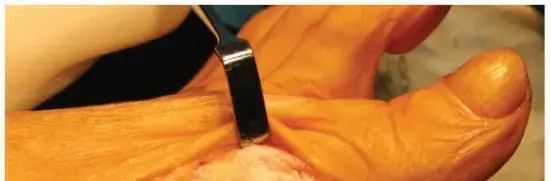 صورة توضيحية لـ تصحيح إبهام القدم الأروح (الوكعة): دليل شامل من الأستاذ الدكتور محمد هطيف