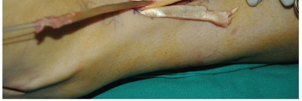 Illustration 53 for Restore Movement: Tendon Transfer for Common Peroneal Nerve Foot Drop