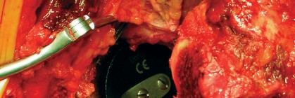 Illustration 52 for Cemented Component Longevity: The Critical Margin of the Acetabulum