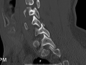 Illustration 16 for Adjacent Segment Degeneration: Your Next Spine Case Solved