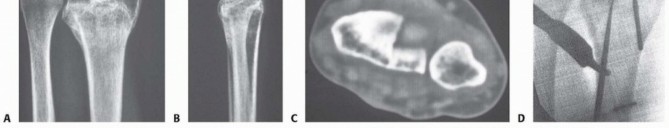 Illustration 28 for Precision Correction for Distal Radius Malunion
