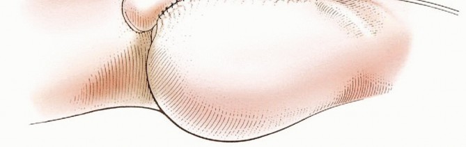 Illustration 33 for Mastering Hip Disarticulation: Through the Hip Joint Capsule