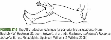 Hip Dislocations: Understanding Causes, Risks, & Outcomes