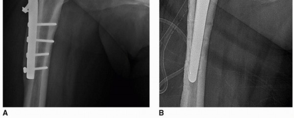 Illustration 9 for Sliding Trochanteric Osteotomy: Modern Role & Refined Techniques