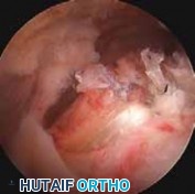 Illustration 14 for Resolve Long Head Biceps Pain: Advanced Arthroscopic Treatment