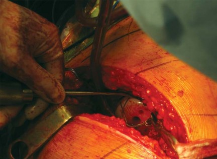 Illustration 35 for Metal on Metal Resurfacing: Enhanced Posterior Soft Tissue Repair