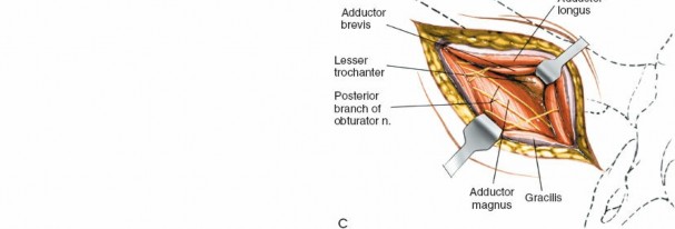 Illustration 219 for Unlocking Every Aspect of the Hip's Surgical Approaches