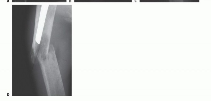 Illustration 3 for Plain Radiograph Showing MBD: Surgical Planning to Prevent Failures