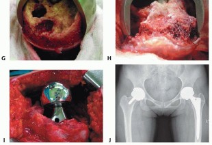 Illustration 15 for Hip Resurfacing: The Bone-Sparing Solution around the Femoral Head