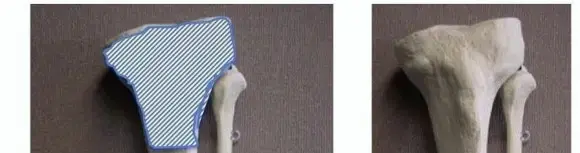 كسور قصبة الساق (عظم الساق): الأسباب، الأعراض، وطرق العلاج الحديثة في اليمن