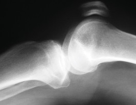 صورة طبية: جراحة استبدال مفصل الركبة الجزئي (UKA): تجنب الأخطاء والاستفادة القصوى في صنعاء مع الأستاذ الدكتور محمد هطيف