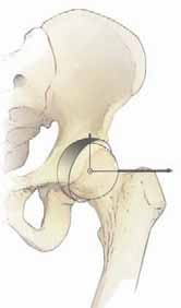 Illustration of periacetabular osteotomy periacetabular - Dr. Mohammed Hutaif