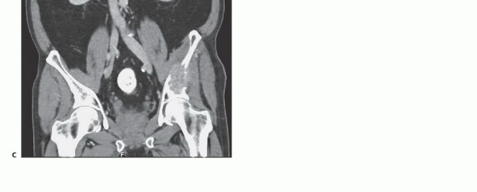 Illustration 9 for Pelvic Metastasis Surgery: A Component of the Utilitarian Approach