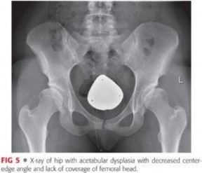 Illustration 16 for Precision Hip Arthroscopy: Unlock Access to the Peripheral Compartment